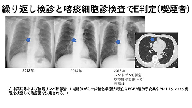 肺がん検査画像